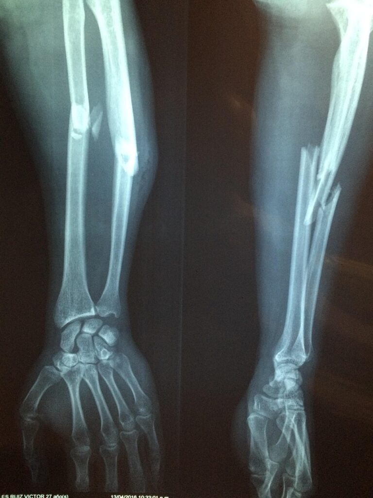 fracture bone, xray, skeleton, diagnosis, broken, health, hospital, radiology, surgery, fracture, orthopedic, care, disease, trauma, patient, medicine, healthcare, pain, arm, injury, ill, problem, suffer, therapy, medical, painful, hurt, xray, xray, xray, xray, xray